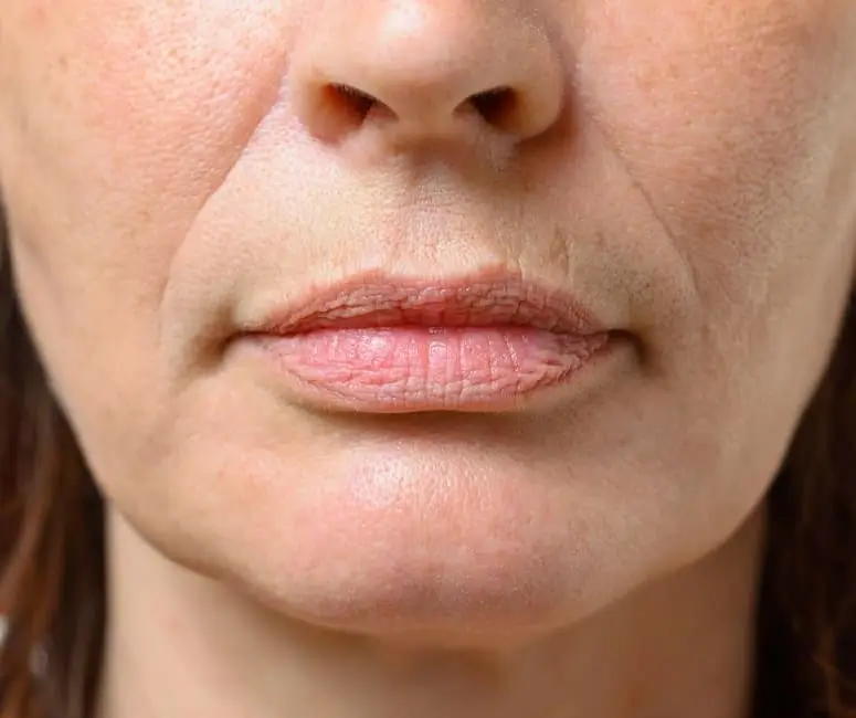 Novo-Skin-Clinic-Smokers-Lines